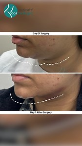 1.4K views | Double Chin And Jowl Removal With Micro Liposuction...