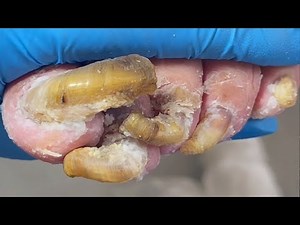 Extra Long And Twisted Onychomycosis, Be Careful When Trimming【Podiatry Clinic】