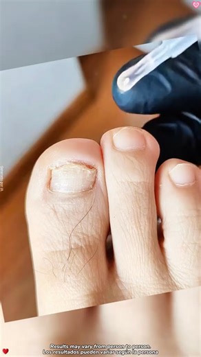 🦶✨ Toenail Fungus Treatment Extra Strength✅ Potent formula targets stubborn nail fungus💅 Restores healthy, clear-looking nails🌿 Gentle yet effective with natural ingredients🏠 Easy at-home application for visible results. | Michael Smith Loy