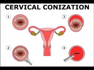 Cervical conization removal of affected tissue or Cold knife conization or cone biopsy of Cervix