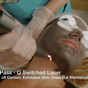 48K views · 90 reactions | OUR NEW HERO FACIAL !!! CARBON LASER PEEL...