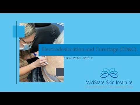 Electrodesiccation and Curettage (ED&C)- performed by Allison Weber, APRN-C