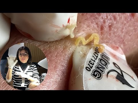 Acne Treatment Huong Da Nang#564 | 2023