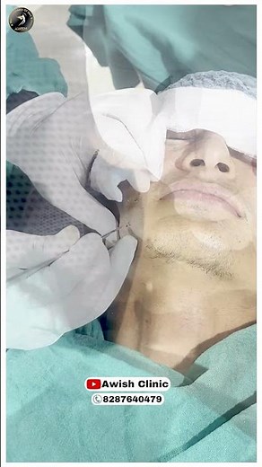 "Watch This Sebaceous Cyst Removal Surgery - Step-by-Step Guide" #awishclinic #sebceous #skincare