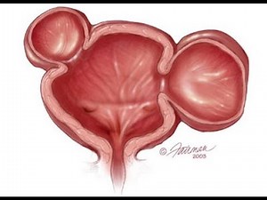 Bladder Diverticula or Diverticulum (pouches or outpouchings in the bladder wall) ; Causes, Symptoms
