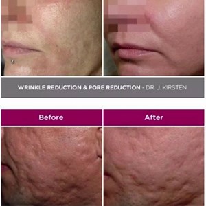 The secret is out. @serenity_cosmeticcenter Now with Radio Frequency microneedling. Secret RF Microneedling is the latest anti-aging technology that safely and effectively returns your skin to a more youthful and radiant state. RF Microneedling is one of the most effective skin-tightening treatments to improve fine lines and wrinkles, especially around the eyes, mouth and cheeks. RF Microneedling also reduces pore size, acne scars and stretch marks. Call or WhatsApp 971 52 126 6664 for more info