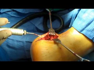 Retrocalcaneal Heel Spur Reduction and Repair of Achilles Te