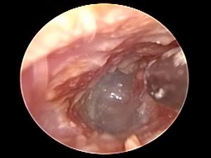 Otoendoscopic Ear Cleaning : Earwax , Otomycosis , Diffuse Otitis Externa