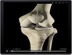 Intramedullary nailing... | Physiotherapy DPT