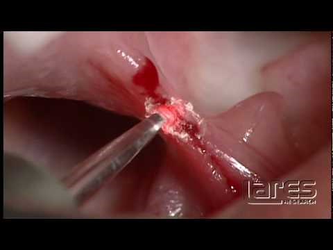 Laser Lingual Frenectomy - Lares PowerLase AT