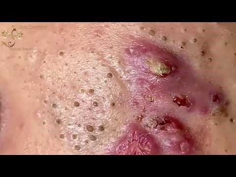 Blackheads Extraction Whiteheads Removal Pimple Popping #1