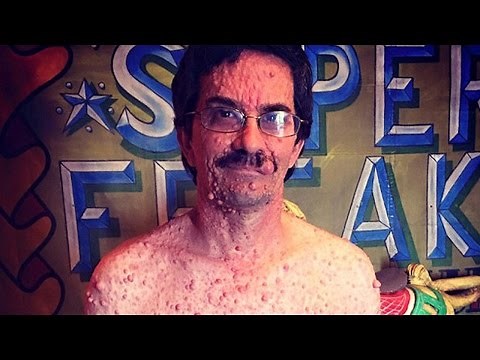 The Real Life Bubble Skin Man – Super Rare Condition
