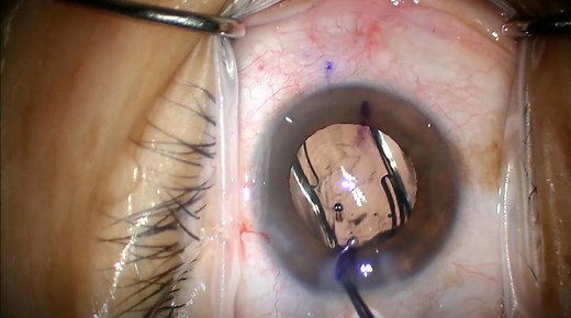 Synergy Toric IOL Implantation - Eyetube