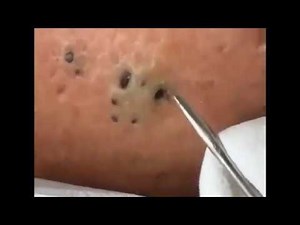 Biggest blackhead ever | Best Blackhead Removal Ever