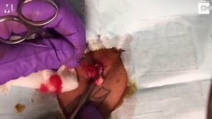 Large gruesome cyst being popped at the base of the neck