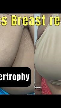 Breast reduction by Laser Liposuction - Result after 1 week| Breast reduction surgery in Ranchi