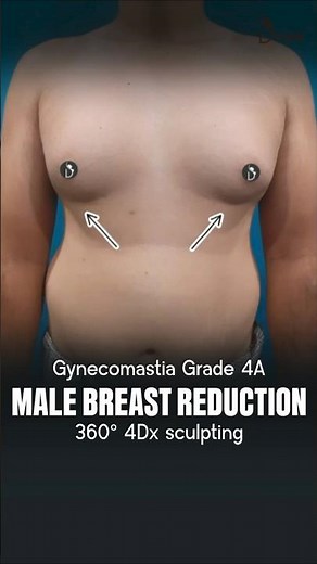 Gynecomastia Grade 4A | Male Breast Reduction Before and After