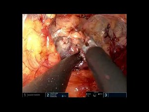 Extraperitoneal robot-assisted laparoscopic radical prostatectomy, DaVinci SP