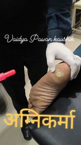 Agnikarma is a part of ayurvedic surgery to remove foot corn #viralreelschallenge2025viralreelschallengejaiviralreelschallengeviralreelschallengechallenge | Vaidya Pawan Kaushik