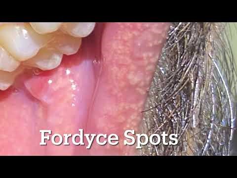 Fordyce Spots- white yellow bumps over lips and cheek. Should I worry?