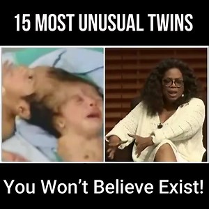 15 Most Unusual Twins You Won’t Believe Exist! | Extra Alien