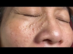 Make your Acne Treatment Huong Da Nang#502 | acne 2022 PArt 1