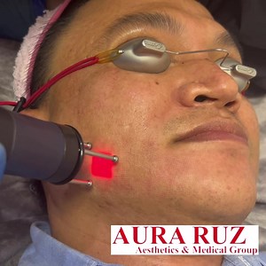 DERMABLATE MCL31 TIMOG (Fractional Laser) 3 sessions for Only P15,000 ✅BUTAS BUTAS FACE(BAKO BAKO FACE) -OLD SCAR-DARK SPOTS-MELASMA-BIG PORES- ICEPICK SCARS OILY SKIN-DARK ✅spots-PISO Scar-WRINKLES-UNEVEN SKINTONE-✅STRETCHMARKS MACHINES : DERMABLATE MCL31 ☑️The erbium laser (MCL31 Dermabalate) treats wrinkles, acne scars, crow's feet, cholesterol deposits (xanthelasma) and other unsightly skin alterations. With the laser, precise work is guaranteed during skin ablation and rejuvenation. PISO SC