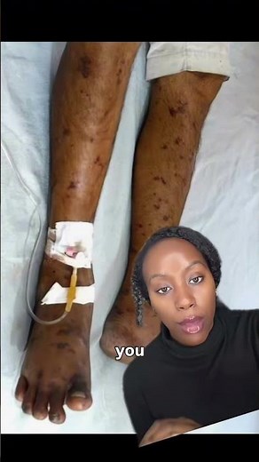 Meningitis Rash in Darker Skin: What It Looks Like and Why It Matters