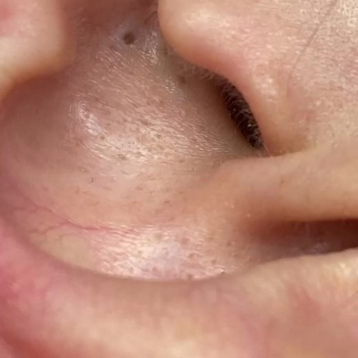 Popping ear blackheads video | Ciara Jonathan