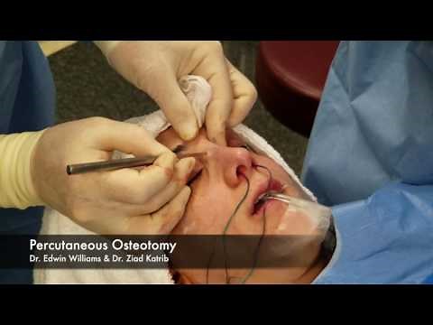 Percutaneous Osteotomy & Breaking the Nose During Rhinoplasty Surgery