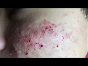 Removal of Blackheads