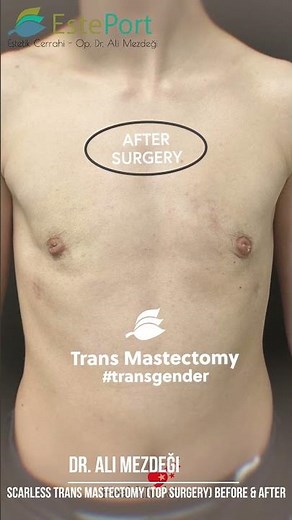 Scarless Trans Mastectomy (Top Surgery) Before & After | Dr. Ali Mezdegi