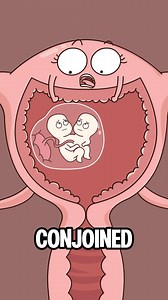 Conjoined twins (medically known as "conjoined twins") form when a single fertilized egg fails to completely separate into two independent embryos in early pregnancy. This incomplete separation results in the twins remaining connected in certain parts of their bodies, sharing some organs or tissues. It is a rare embryonic developmental accident. #conjoinedtwins#pregnancy#twins#funny#hot#animation#short#humor#science#know-how#health #medicalfacts#humanbody#bodyhealth#scienceexplained#uscomedy | S