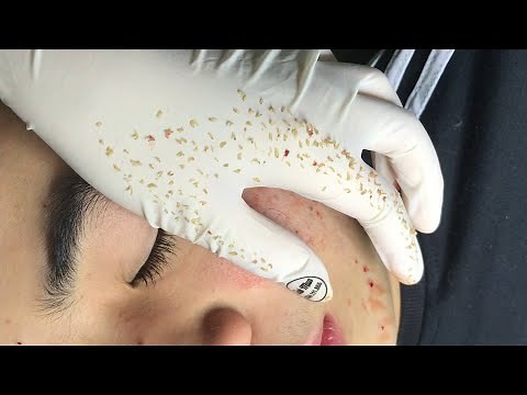 Treatment acne under the skin | Spa Linh Mun Acne Treatment