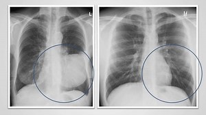 If you want to become really good at reading chest X-rays, you need to know how borders are formed. Essentially, borders appear on the image when structures of different density (e.g., soft tissue and air) touch one another. Find out more in this video from our Chest X-Ray Essentials course: http://bit.ly/2XZAv3Y | Medmastery