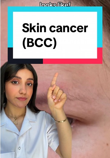 Check for Signs of Skin Cancer: Early Detection Matters
