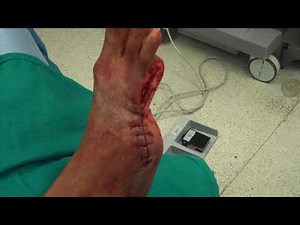 SURGICAL CASE (AFTER) : WET GANGRENE SECONDARY TO DIABETES AND SEVERE VASCULAR DISEASE