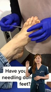 Dry needling is a technique where thin needles are inserted into...