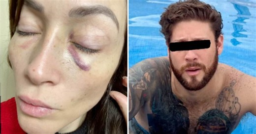 Actriz Laura Vignatti muestra los golpes que le propinó su ex