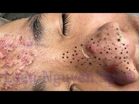 Blackhead Removal With Sac Dep Spa @100074664