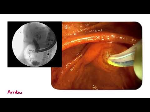 Dr. Sam Serouya Performs & Narrates a Sphincterotomy and Stent Placement Using the aScope™ Duodeno