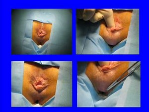 Constipation & Fecal Incontinence Lecture