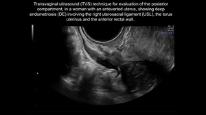 UOG videoclip: Transvaginal ultrasound for diagnosis of deep endometriosis involving uterosacral ligaments, torus uterinus and posterior vaginal fornix: prospective study