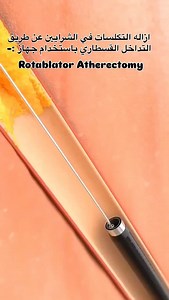 Rotablator atherectomy is still used today, but mainly as a niche tool for severely calcified, undilatable coronary lesions, preparing them for stent placement. with its use decreasing overall due to better stent tech but increasing for complex cases like in elderly/diabetic patients with heavy calcium. Modern techniques focus on precise lesion prep (sanding calcification), incorporating drug-eluting stents (DES) for better long-term results, and advancements in systems (like RotaPro) make it sa