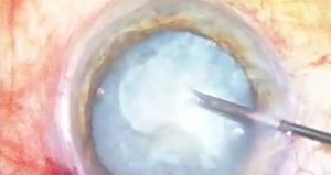 Capsular Fibrosis - Eyetube
