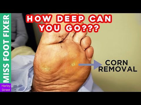 HOW DEEP CAN YOU GO ??? FOOT CORN REMOVAL BY MISS Foot Fixer Marion Yau