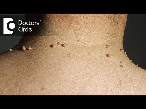 How do you get rid of skin tags naturally? - Dr. Madhu SM