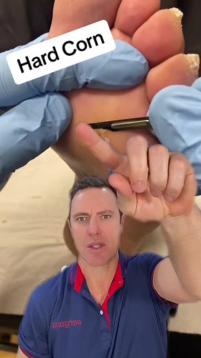 Hard Corn Removal Procedure by a Podiatrist