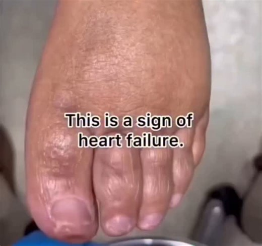 18 reactions | Edema, or swelling, is a common sign of heart failure because the heart isn't pumping blood as well as it should. When the heart is weak, fluid starts to build up in the body, especially in the legs, feet, and sometimes even the lungs. #TheFacts #viralvideo #Socialmedia #Instagram #reels | The Facts | Facebook