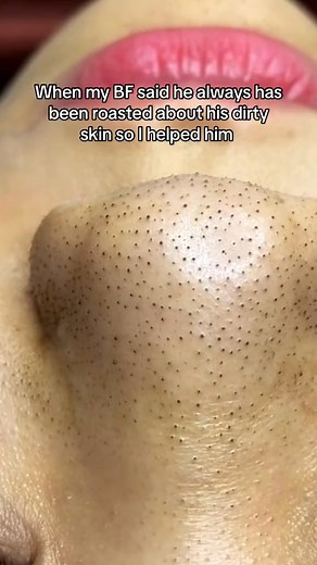 #fypシ #foryoupage #skincaretips #skincaretip #skincareroutines #pimplepopperaddict | neay kruen